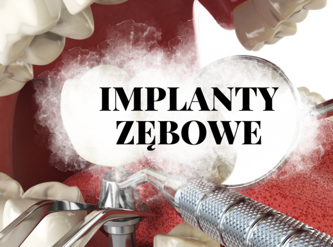 Implanty zębowe