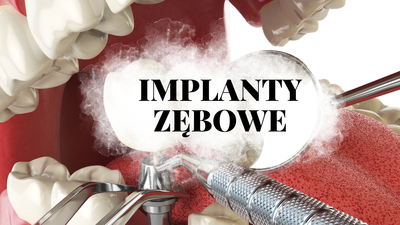 Implanty zębowe