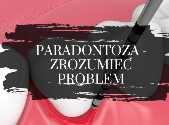 paradontoza - zrozumieć problem