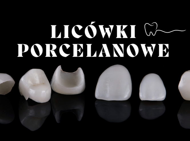 Licówki porcelanowe