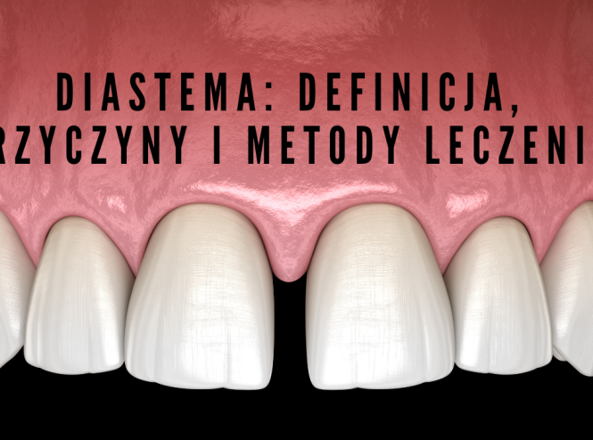 Diastema Definicja, przyczyny i metody leczenia