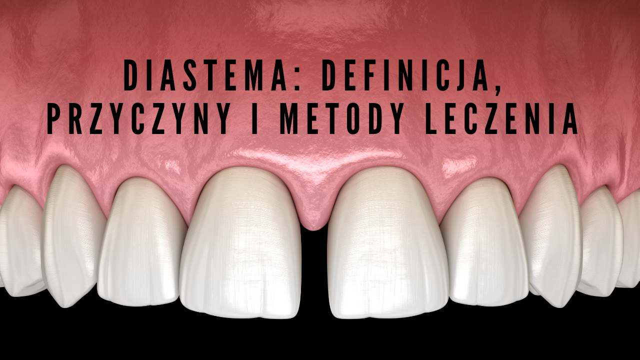 Diastema Definicja, przyczyny i metody leczenia