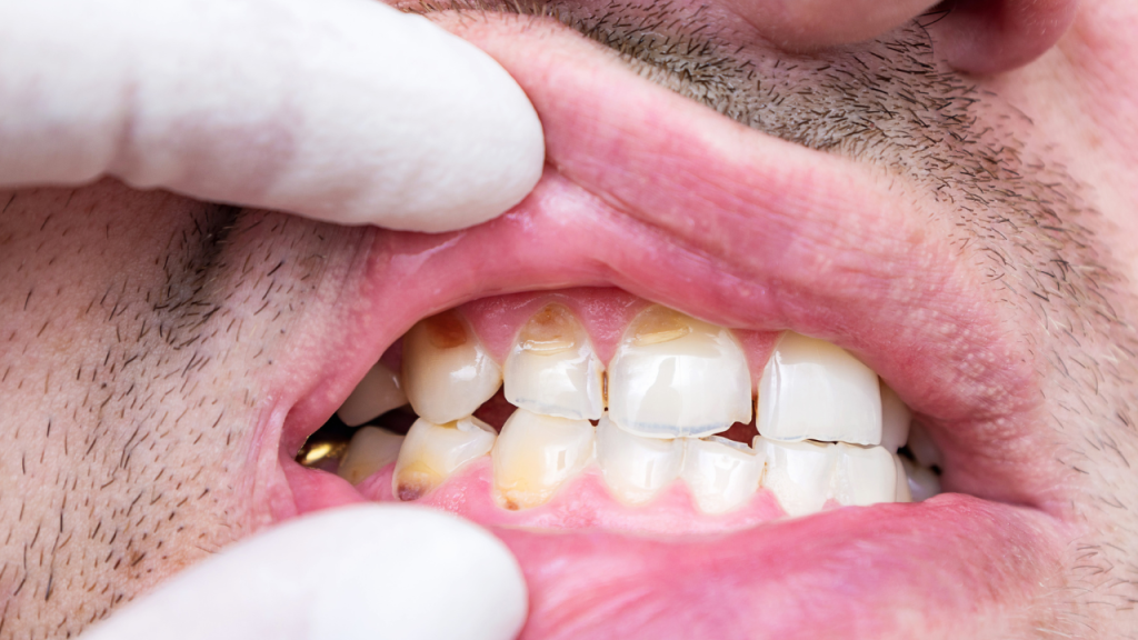 kwasowa erozja szkliwa - nieodwracalna utrata tkanek zębów