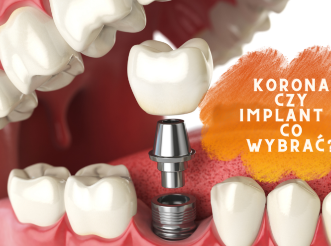 korona czy implant - co wybrać