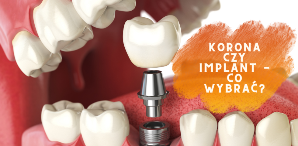 korona czy implant - co wybrać