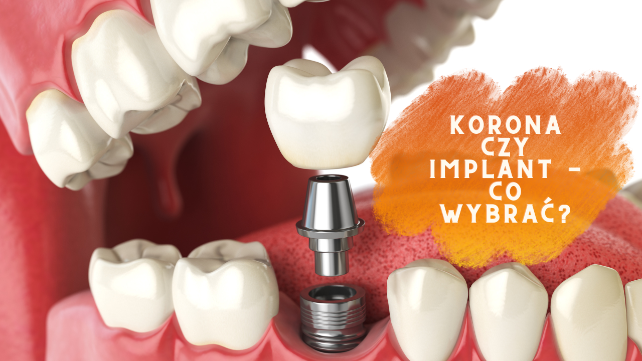 korona czy implant - co wybrać
