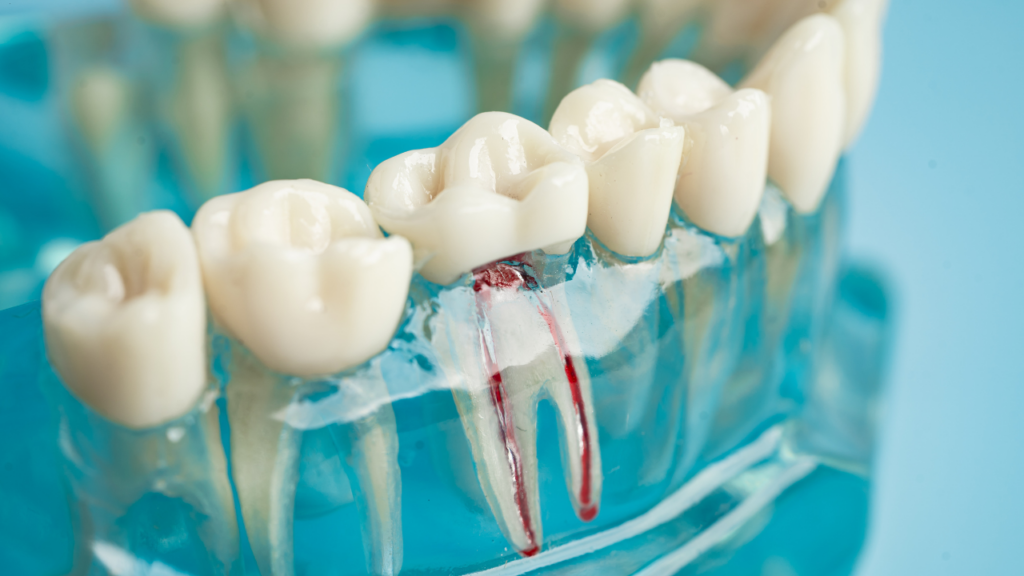 Torbiel zębowa - w jaki sposób powstaje?