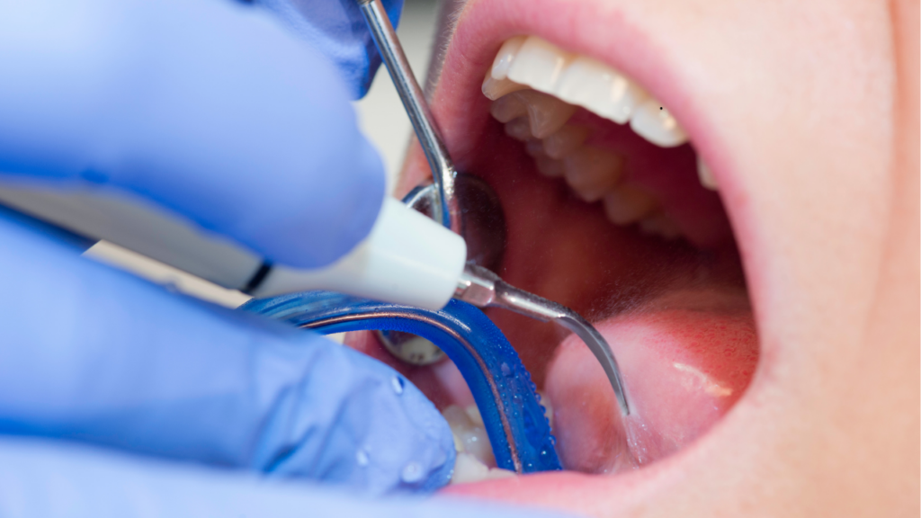 Usuwanie kamienia nazębnego - rutynowy zabieg higienizacyjny.png
