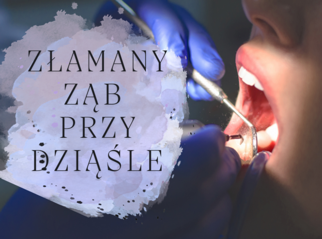 Złamany ząb przy dziąśle - co robić i jak wygląda leczenie
