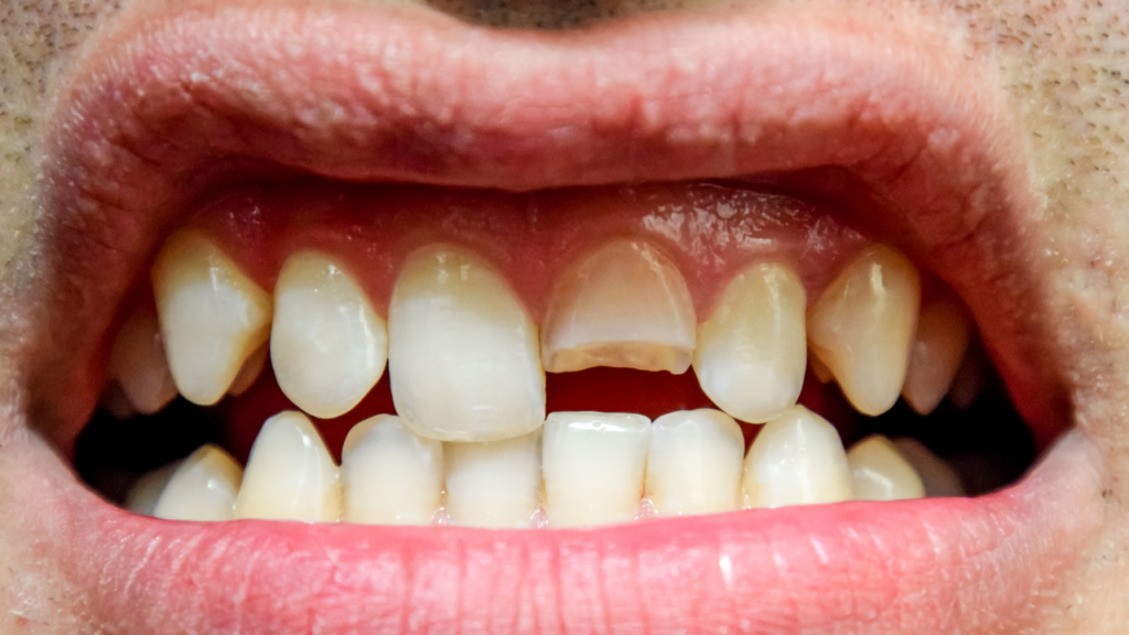 Złamany ząb przy dziąśle - jakie wyróżniamy rodzaje złamań