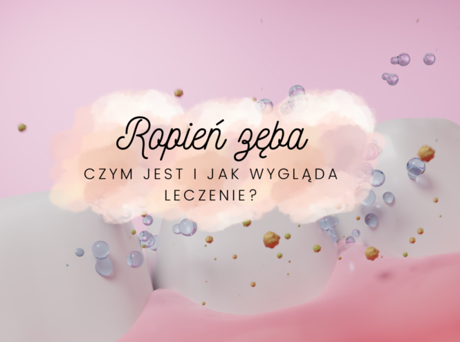 Ropień zęba - czym jest i jak wygląda leczenie