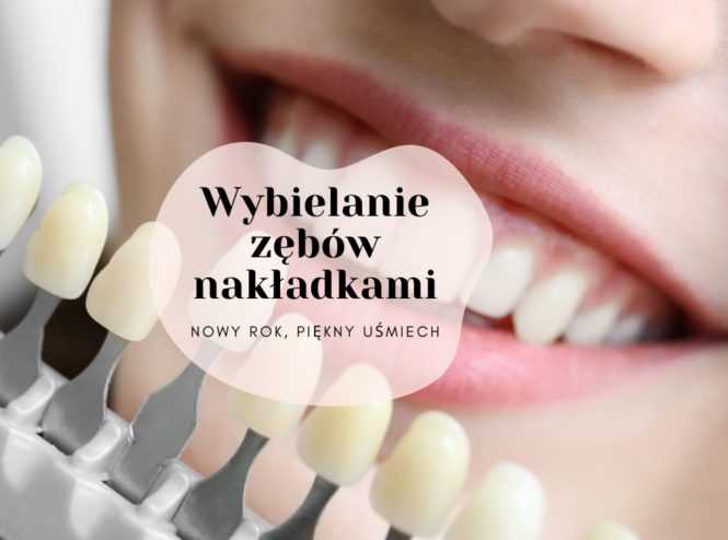 Wybielanie zębów nakładkami - nowy rok, piękny uśmiech