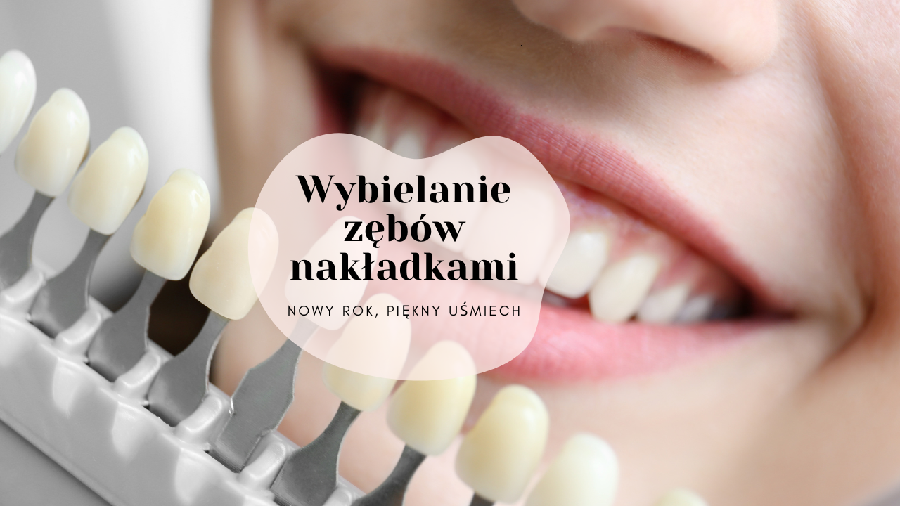 Wybielanie zębów nakładkami - nowy rok, piękny uśmiech