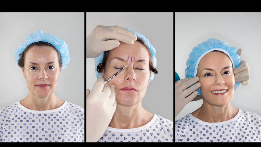 Zabieg botoksu - redukcja zmarszczek i zapobieganie ich pogłębienia