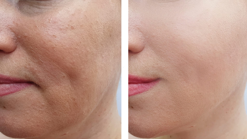 Botoks - wygładzenie skóry i młodszy wyglądd