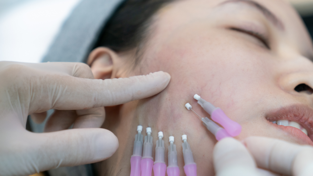 Zmarszczki marionetki - alternatywy dla botoksu 