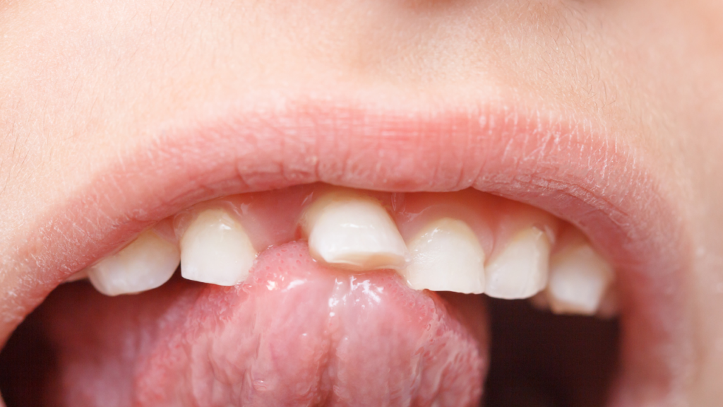 Zęby mleczne - od czego zależy czas wypadania zębów u dzieci?