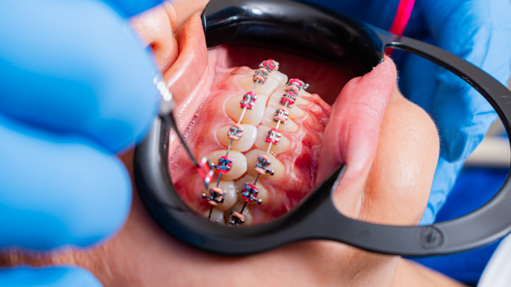 Aparat ortodontyczny przed i po - czy leczenie jest zarezerwowane tylko dla młodych?