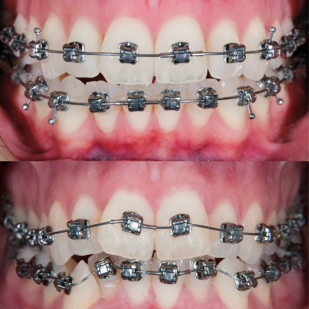 Aparat ortodontyczny przed i po - efekty leczenia 