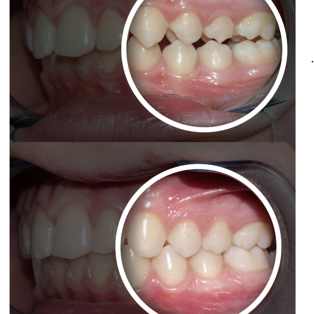 Aparat ortodontyczny przed i po - efekty leczenia ortodontycznego