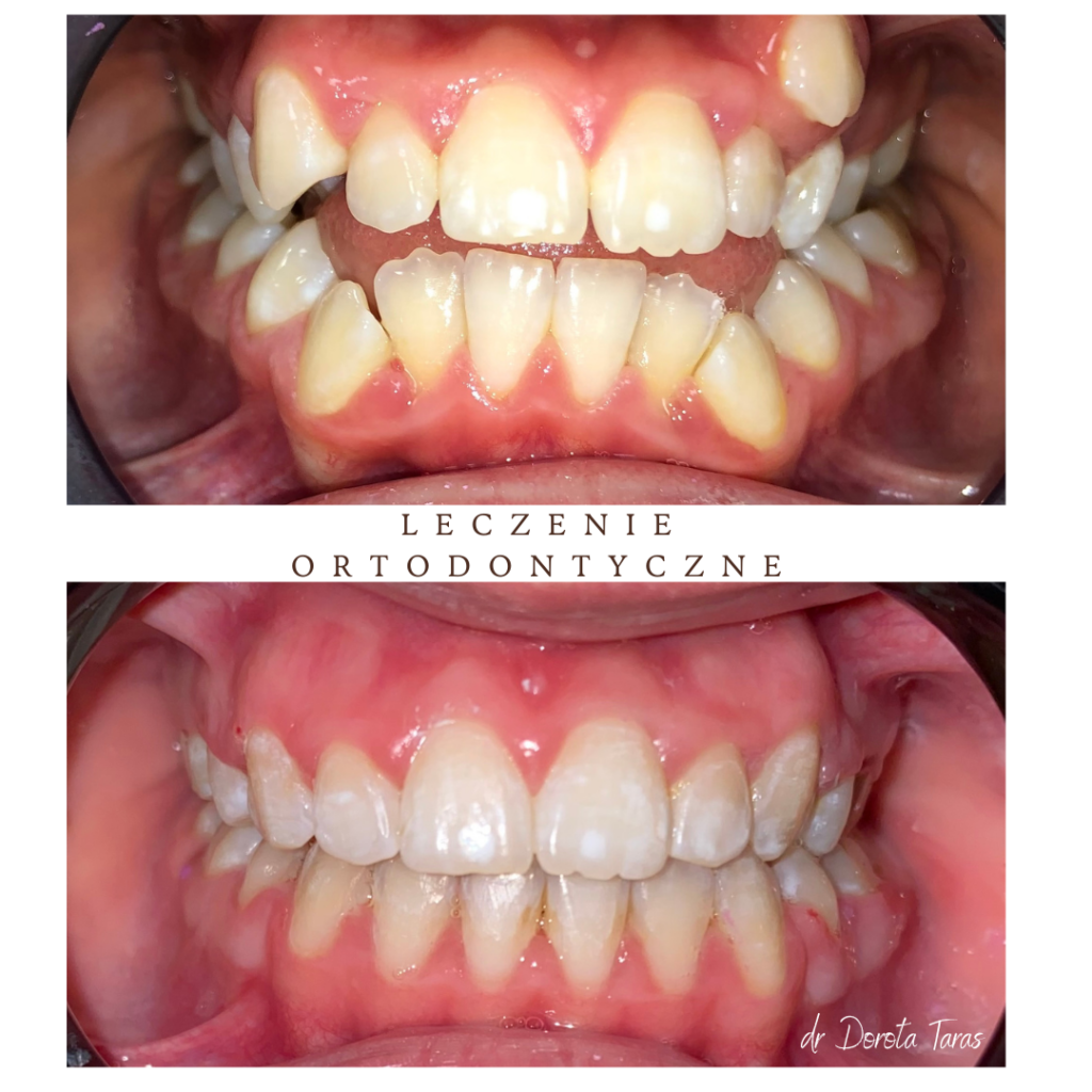 Leczenie ortodontyczne - metamorfoza pacjenta w naszym gabinecie