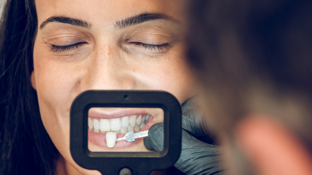 Licówki na zębach - jak wygląda proces zakładania licówek?