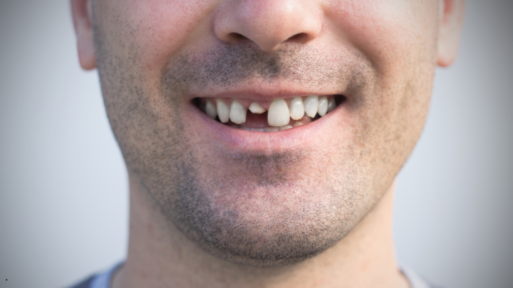 Odbudowa zęba –to nie tylko kwestia estetyki, ale przede wszystkim potrzeba przywrócenia jego funkcji i struktury