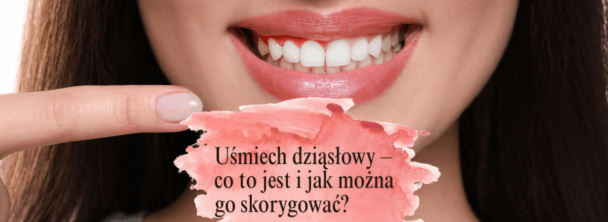 Uśmiech dziąsłowy – co to jest i jak można go skorygować?