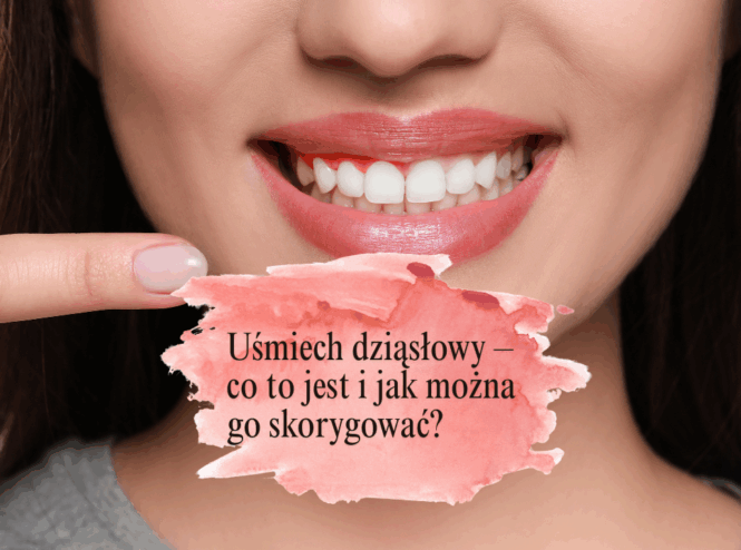 Uśmiech dziąsłowy – co to jest i jak można go skorygować?