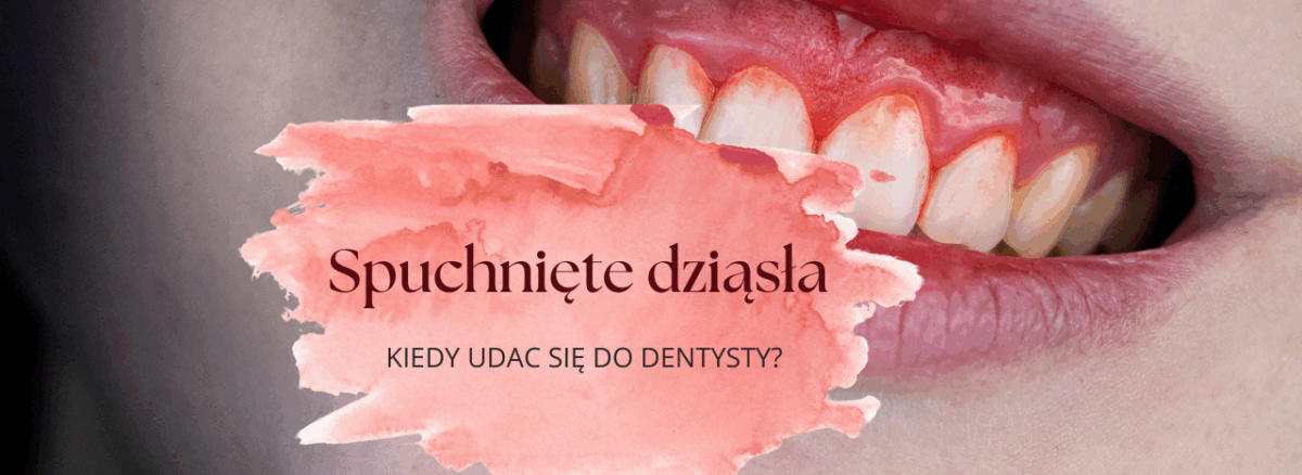 Spuchnięte dziąsła - kiedy się zgłosić do dentysty?