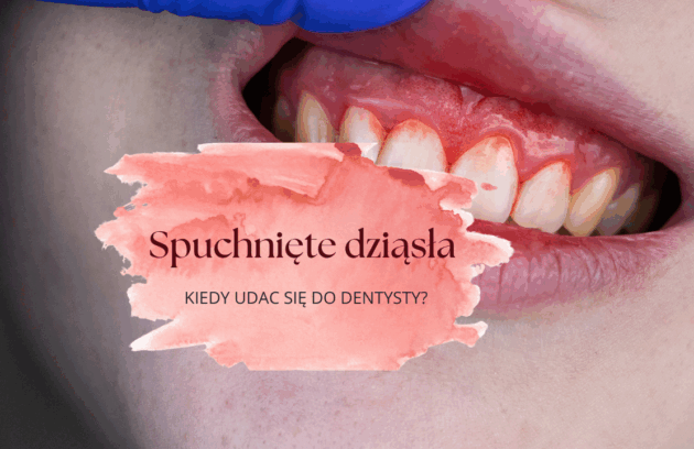 Spuchnięte dziąsła - kiedy się zgłosić do dentysty?
