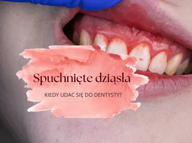 Spuchnięte dziąsła - kiedy się zgłosić do dentysty?