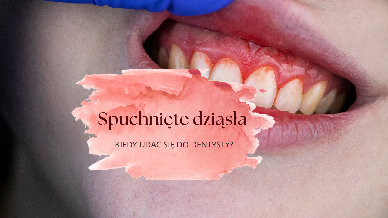 Spuchnięte dziąsła - kiedy się zgłosić do dentysty?