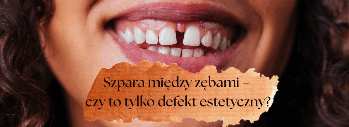 Szpara między zębami – czy to tylko defekt estetyczny?