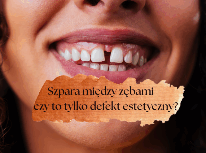 Szpara między zębami – czy to tylko defekt estetyczny?