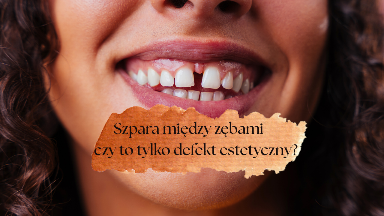 Szpara między zębami – czy to tylko defekt estetyczny?