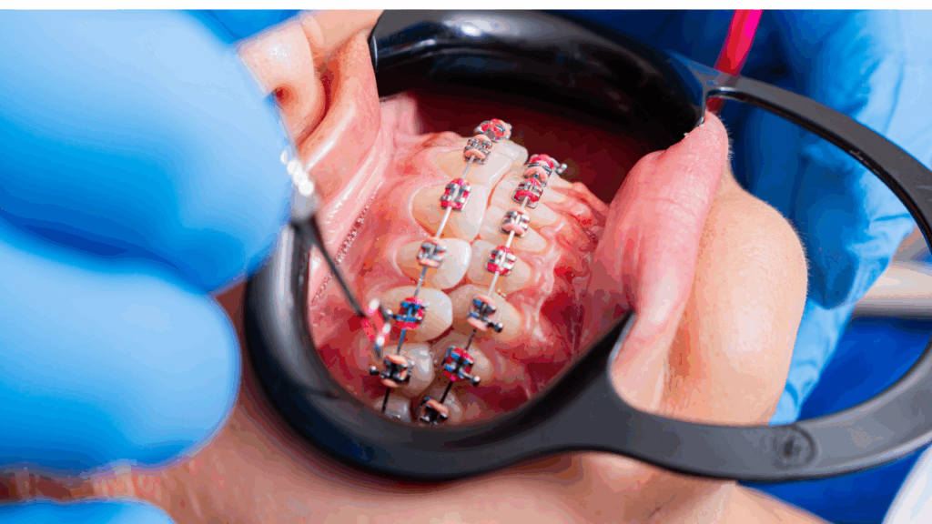 Szpara między zębami –ortodoncja to rozwiązanie