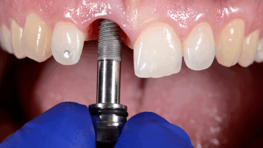 Proces wszczepienia implantu zęba krok po kroku w gabinecie stomatologicznym