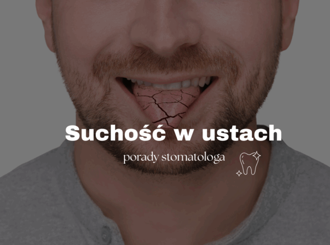 Suchość w ustach – porady stomatologa