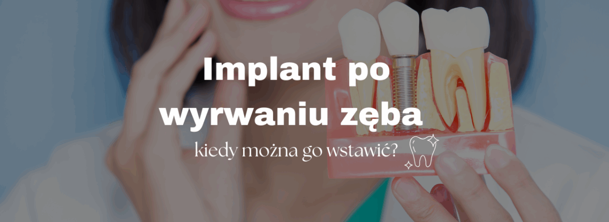Implant po wyrwaniu zęba – kiedy można go wstawić