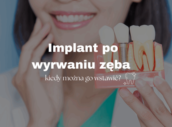 Implant po wyrwaniu zęba – kiedy można go wstawić