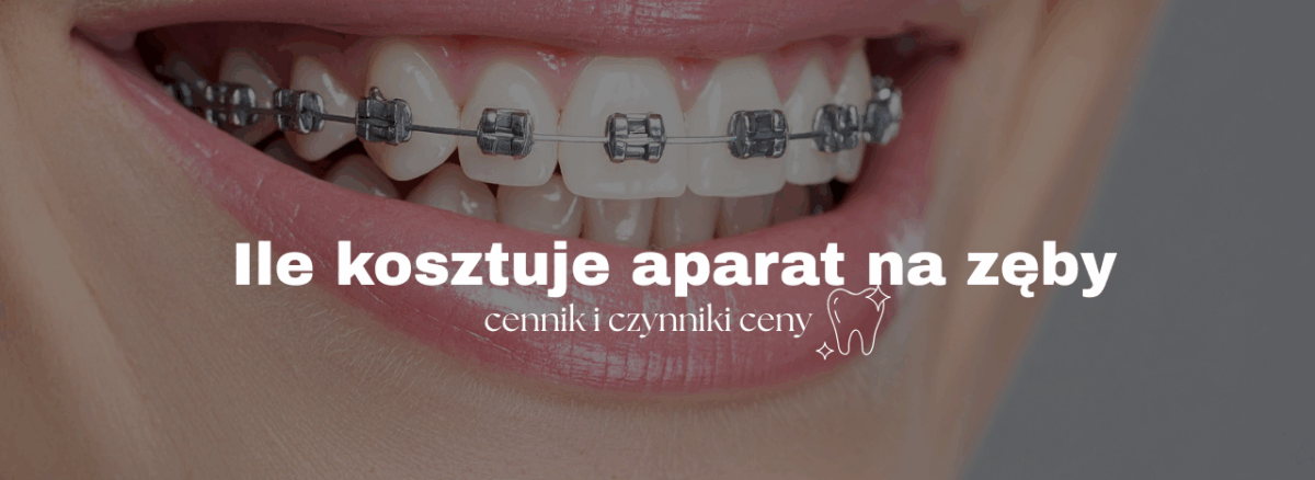 Ile kosztuje aparat na zęby – cennik i czynniki ceny