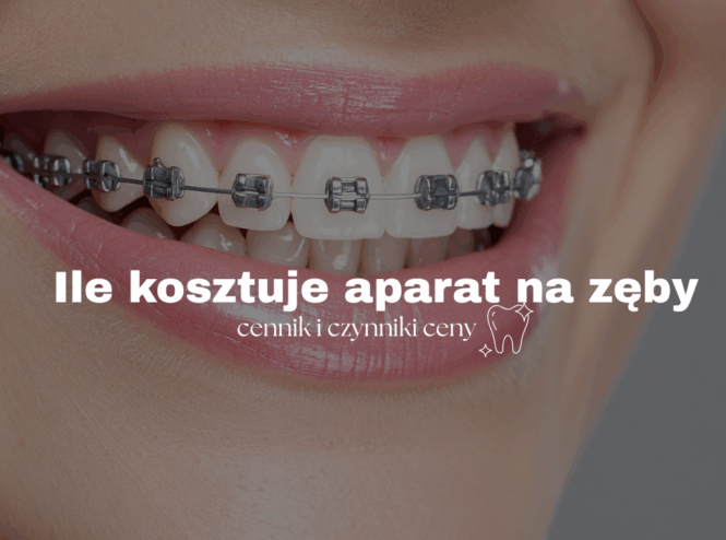 Ile kosztuje aparat na zęby – cennik i czynniki ceny