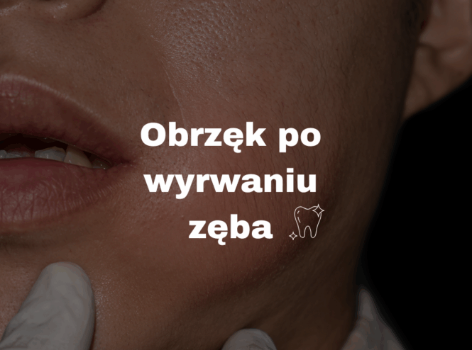 Obrzęk po wyrwaniu zęba
