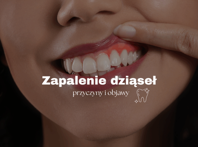 Zapalenie dziąseł – przyczyny i objawy