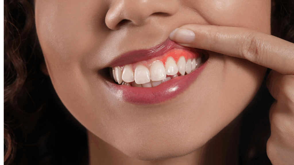 Opuchnięcie i zaczerwienienie dziąseł mogą wskazywać na stan zapalny