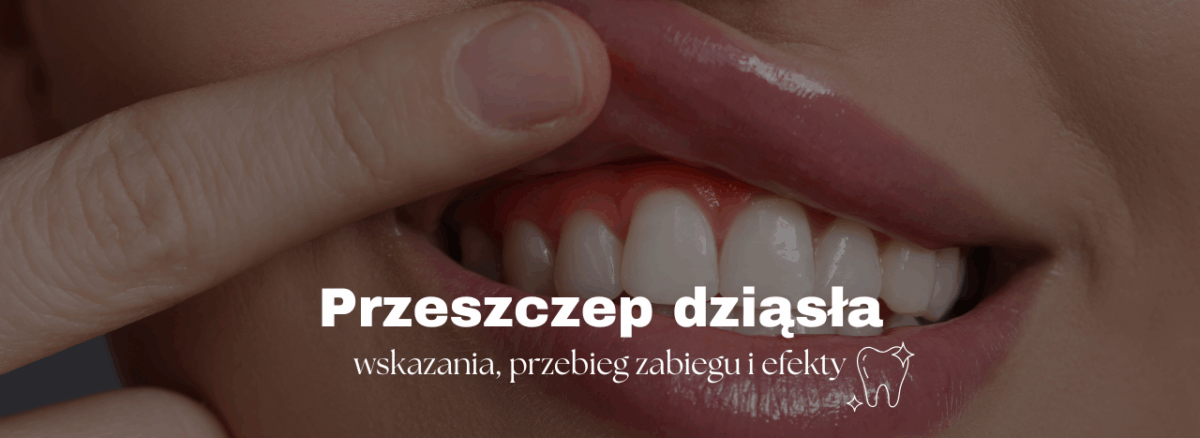 Przeszczep dziąsła – wskazania, przebieg zabiegu i efekty