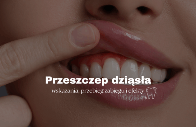 Przeszczep dziąsła – wskazania, przebieg zabiegu i efekty