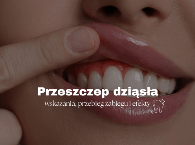 Przeszczep dziąsła – wskazania, przebieg zabiegu i efekty