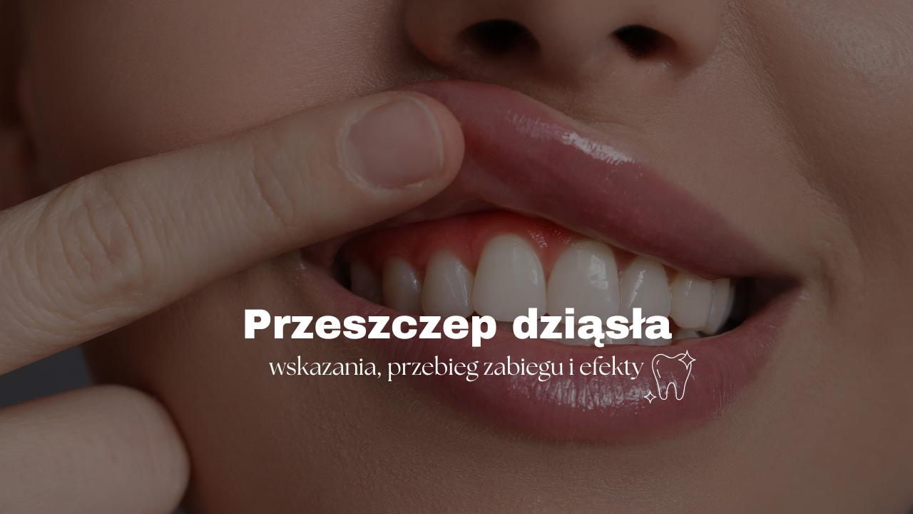 Przeszczep dziąsła – wskazania, przebieg zabiegu i efekty